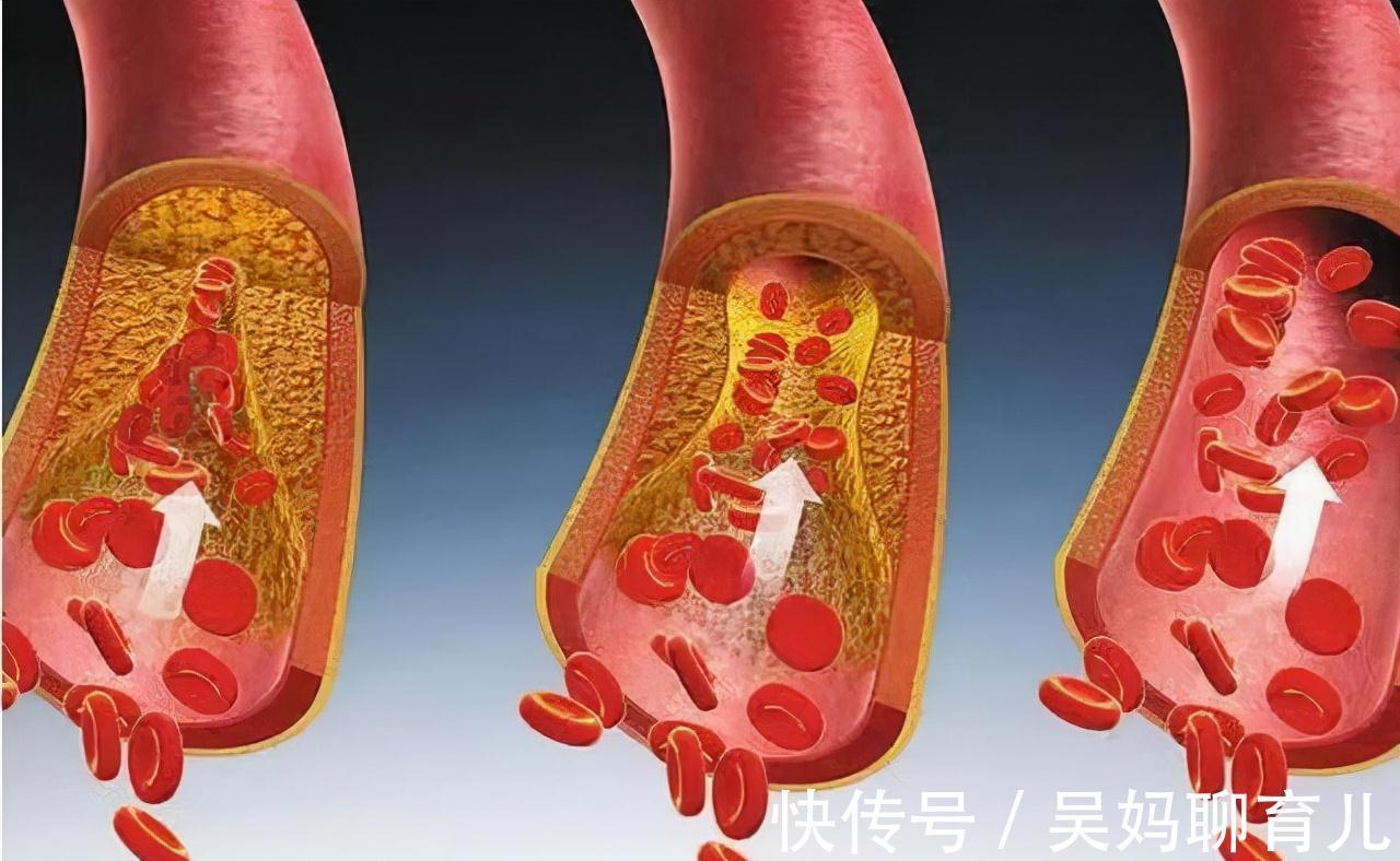 养生|每天一个鸡蛋,是“养生”,还是“损坏心血管”?研究后说出真相