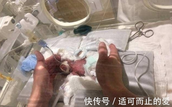 早产儿|美国一女婴出生仅25厘米,体重280克,16年过去现已成女神