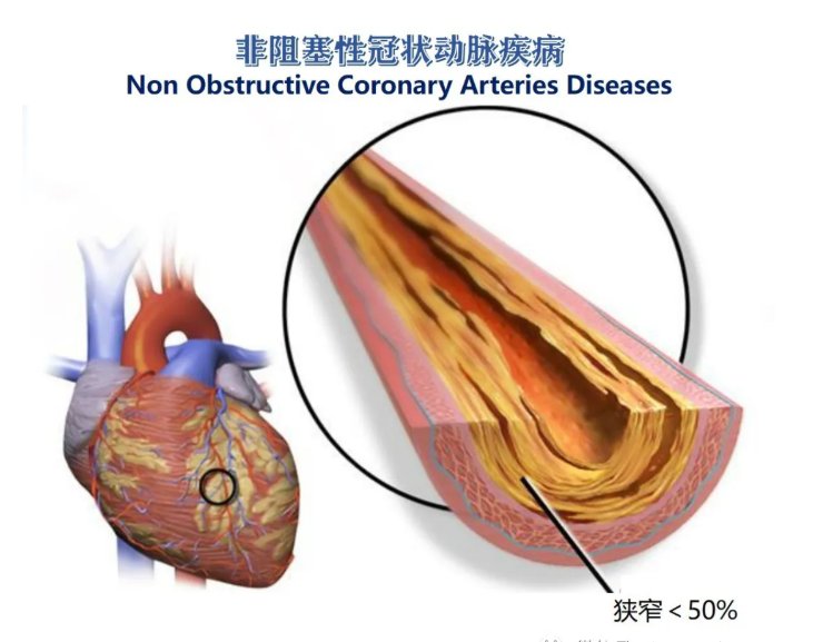 心肌梗死|【健哥说心脏】冠脉有点狭窄，用不用他汀？