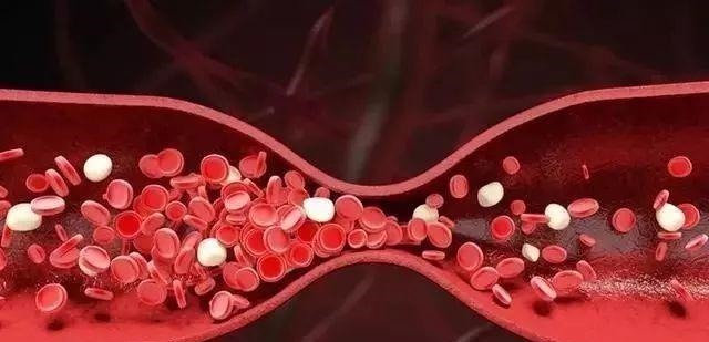 血栓|脑袋里有没有血栓,就看你睡觉有没有这个毛病若没有,恭喜你