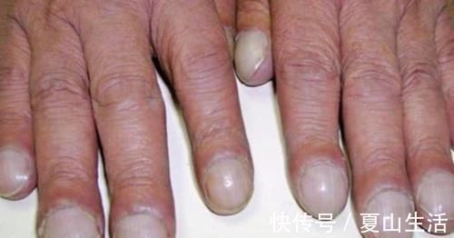 胸痛|出现“1粗1大2痛”的异常表现，警惕肺癌或已上门，及时查肺