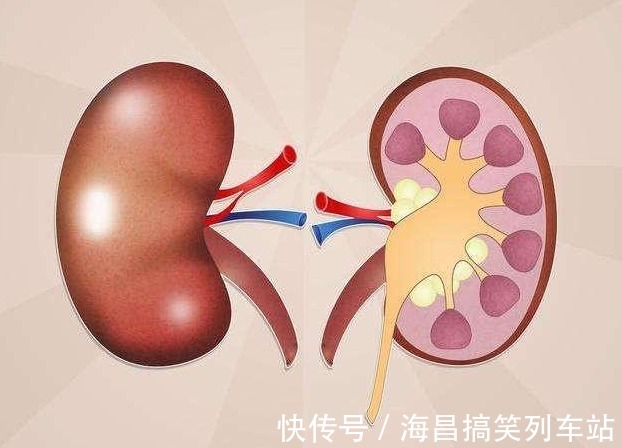 杨桃|尿毒症大多是吃出来的!试着远离三种食物,就能远离尿毒症疾病!