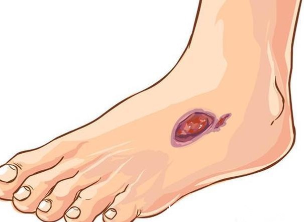 糖尿病足|脚上有4种变化的人,很难躲过糖尿病,占一个,也要注意血糖