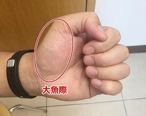 葡萄糖|血糖高不高,看双手就懂?若有这4种症状,或在暗示血糖偏高了