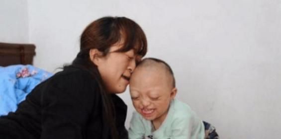 先天|夫妻先天缺陷坚持生孩子, 生下的孩子遗传了家族所有缺陷