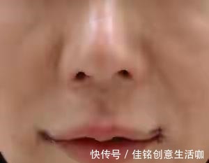 线雕隆鼻 盘点当下“热门医美项目”的几个真相(有些弯路不能走)!