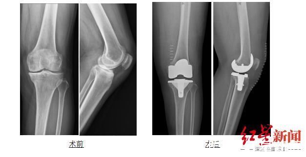 3D打印|世界首例！川大华西医院3D打印人工膝关节植入成功 68岁婆婆恢复正常行走