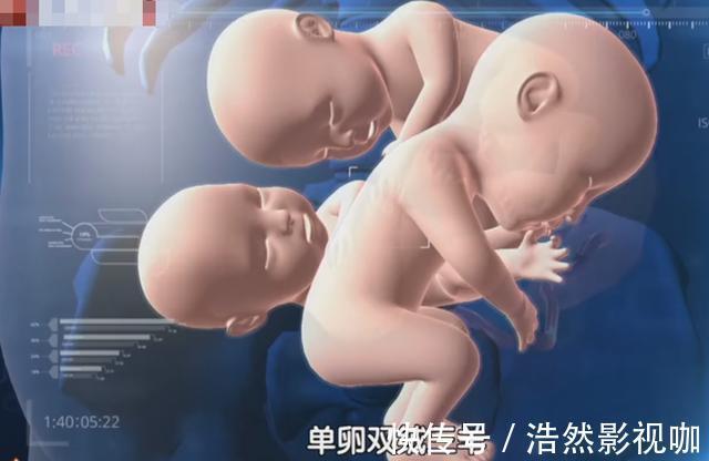 宝妈|90后宝妈怀3胞胎,肚子又大又尖要被“撑破”,医生快提前生吧