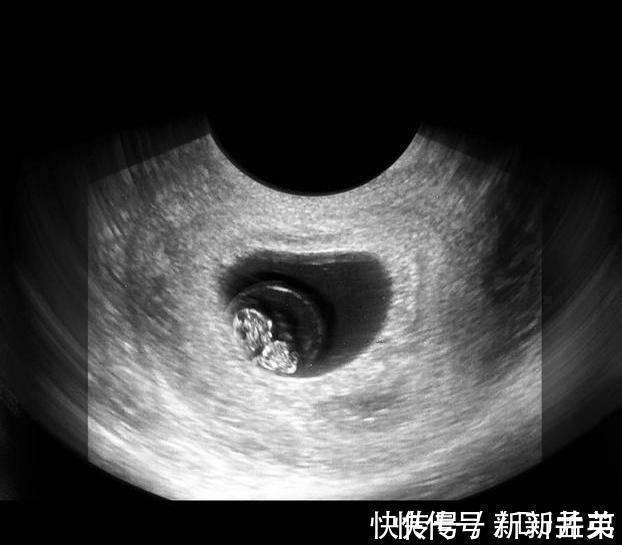 羊水|胎儿从卵泡到性别形成,17张图片清晰诠释,男宝女宝看得很清楚