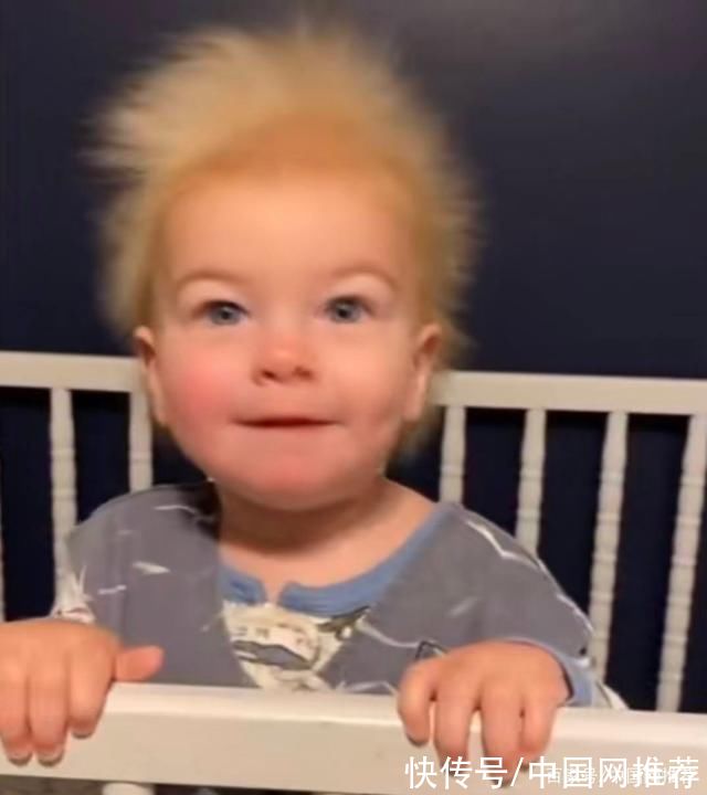 蓬发综合征|美国一男婴拥有爱因斯坦“同款发型”，全球大概有100名类似患者