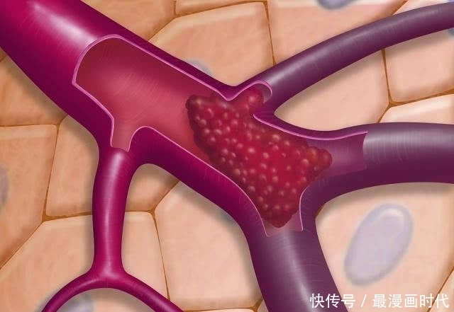变得更干净|藏在身边的“溶栓王”,每天吃一点,赶走血栓,助血管更“干净”