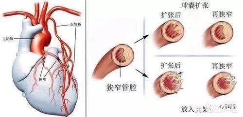 记住：放了心脏支架，绝不是冠心病就治愈了！