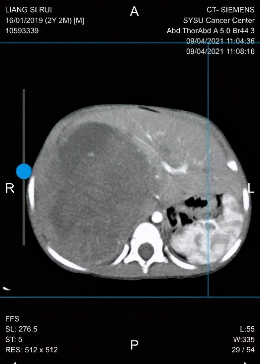 折翼天使们|2岁就查出肿瘤！这些让人心疼的折翼天使们，后来怎么样了？