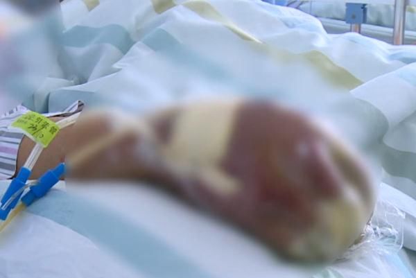 病死率|男子买鱼做大餐却被送进ICU,这个动作害了他