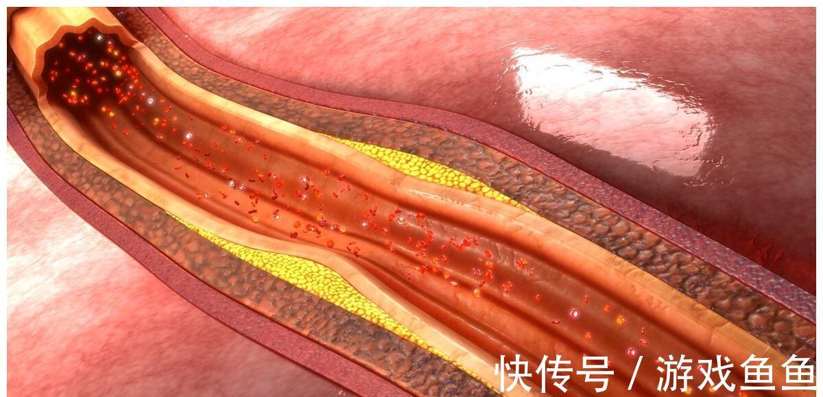 动脉狭窄|如何让动脉狭窄减轻？降低血脂，能使粥样硬化斑块变小吗？