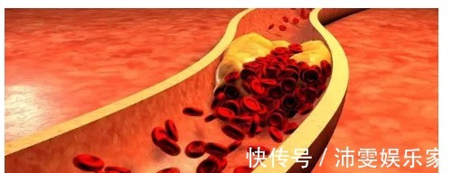 高血脂|不吃药,也能降血脂真的假的医生说确实可以