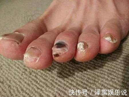 心脏病|心脏好不好,腿脚不会骗你!若腿脚有此三表现,恭喜,心脏还不错