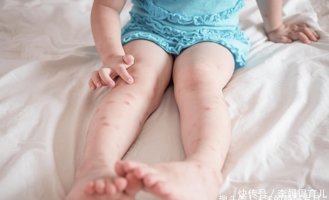 蚊子|嗡嗡嗡,你听你听,蚊子在狰狞的笑,它最喜欢小宝宝