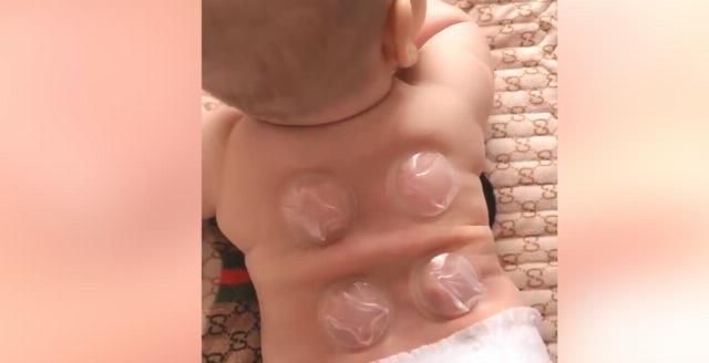 妈妈|妈妈用吃果冻的杯子,给萌娃拔火罐,网友宝宝很享受的样子