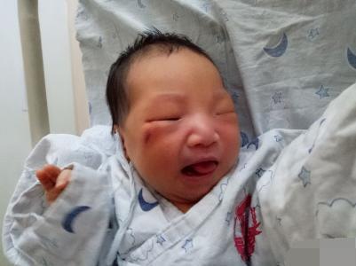 消退|孩子脸部“产钳印”没消退,婆婆怨儿媳没本事顺,网友好心凉