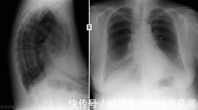 康复|疫情下，肿瘤康复期患者应该怎么吃？如何进行康复训练？