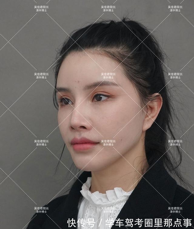 法令纹 32岁姑娘小拉皮术后7个半月,变得年轻又精致,前后反差很大!
