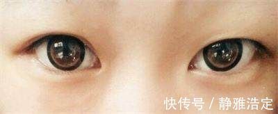 双眼皮|肿眼泡做双眼皮怎么样?肿眼泡做上眼皮效果好吗?