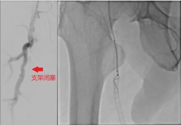 老人5个支架闭塞 4条动脉被堵 市立介入团队挑战医学禁忌成功打通阻塞血管