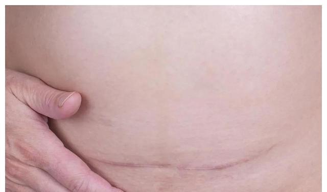 日记|分娩日记14没有羊水+绕颈两圈,胎盘功能三级,立即插队剖腹产