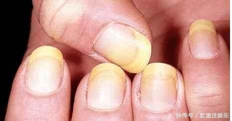 皮肤科|指甲这6个现象，暗示你生病了，要注意，第一个代表患有心脏病