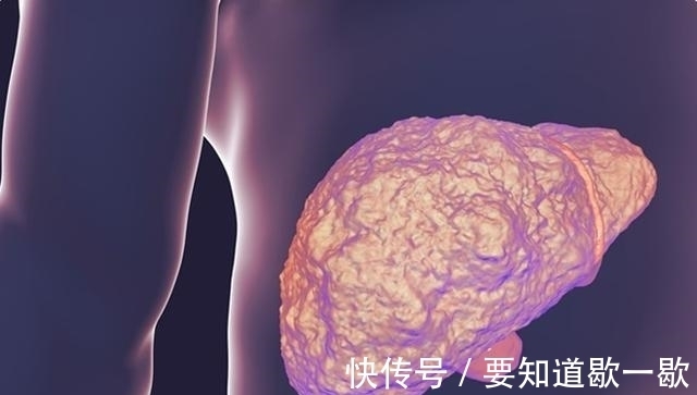 肝硬化|肝硬化不治疗会引起肝衰竭甚至肝癌,一定要做好4点来预防!