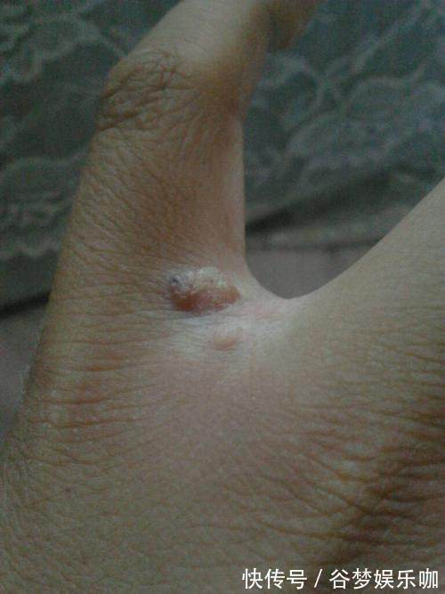 中西医结合杂志|一味“去瘊子”的中药!泡在醋里,外擦患处,中医人的无私分享