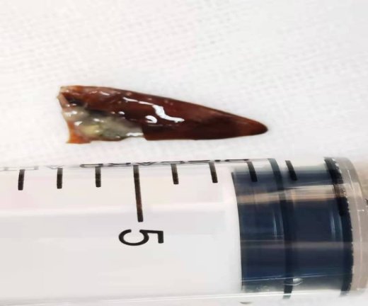 蓝军|都是辣椒尖惹的祸!中国科学院大学重庆仁济医院呼吸与危重症医学科顺利完成支气管异物取出术