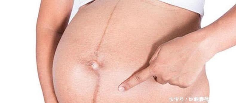 透露|原来孕妈肚子上的“黑线”,透露这些秘密!