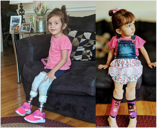 双腿|2岁女孩总发烧家人以为是感冒,送进医院却被立即截去双腿