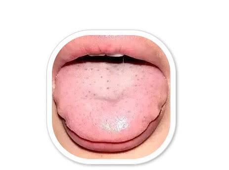 炙甘草|“齿痕舌”摊上大事了!是癌变征兆老中医支3招帮你健脾祛湿!