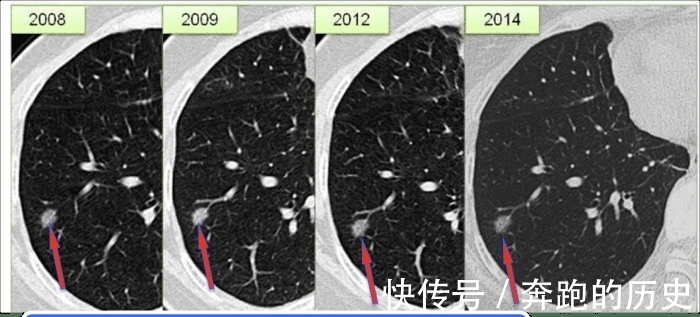 甲状腺癌|担心自己患癌，如何检查才能有效筛查癌症？