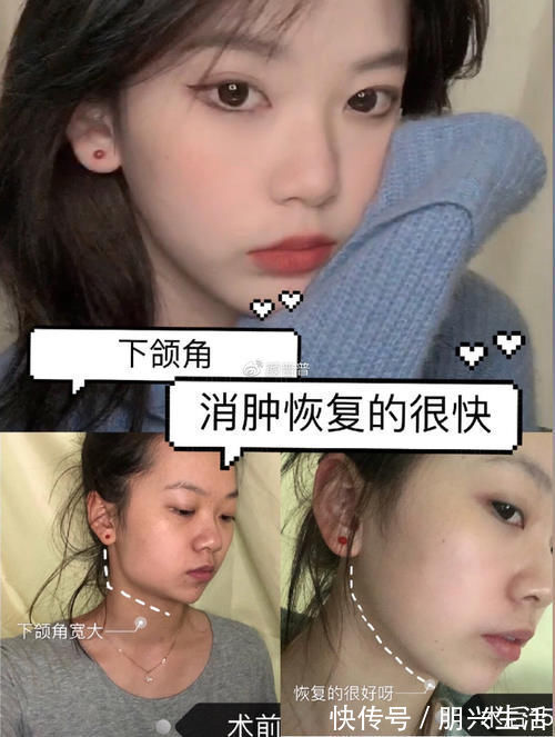 阿斯匹林类药物 关于下颌角手术,大家都会担心后遗症有哪些?有后遗症应该怎么办?