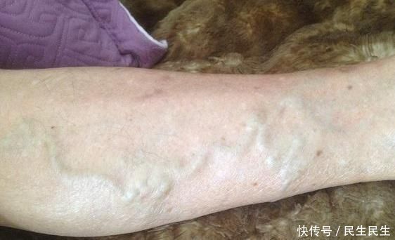 长时间站立,小腿静脉曲张,1剂方子,活血通络,告别“蚯蚓腿”