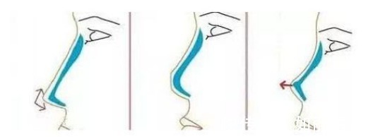 注射隆鼻 隆鼻手术一般多少钱?隆鼻能保持多久?