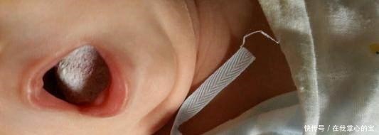 新手妈妈|宝宝有鹅口疮，妈妈护理有妙招，新手妈妈必看！