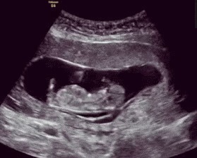 宝妈|胎儿为什么会脐带绕颈多数人以为是受睡姿影响,真相让人意外