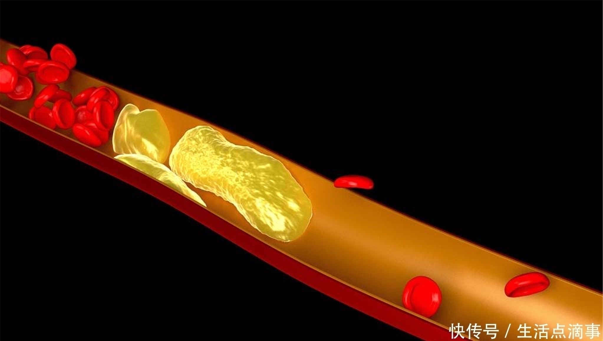 梨子|“溶栓高手”发现了，不是洋葱，隔三差五地喝，血栓也许悄悄没了