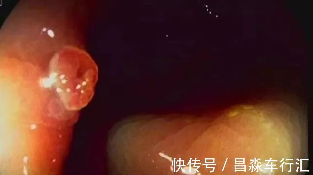 癌变|大家好!我叫“息肉”,癌症的近亲!我最怕无情又温柔的手术刀：艾灸