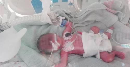 安胎|孕32周见红宫口开一指,为什么医生让至少安胎到34周?