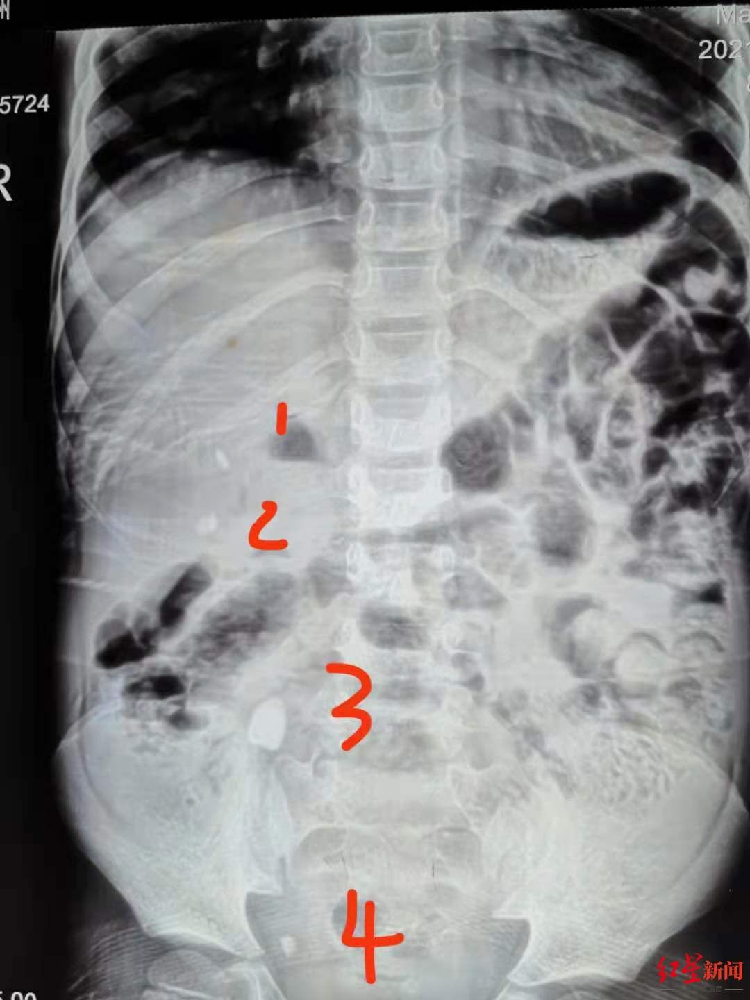 男孩|遗憾！8岁男孩患肾结石拖延一年 如今右肾萎缩，仅存18%肾脏功能