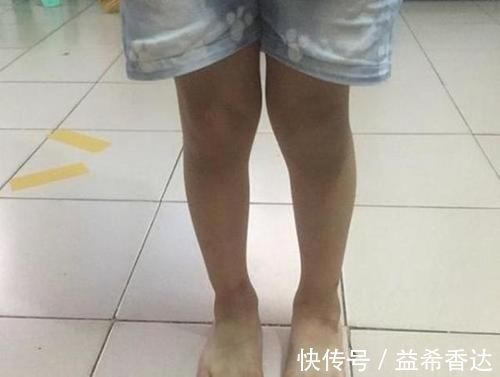维生素d|为什么中国孩子那么多“罗圈腿”，外国却很少，只因家长这些行为