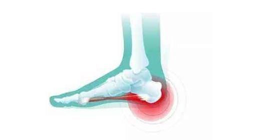 跟骨|足跟痛的5大原因,减轻跟腱对跟骨的拉力,而减轻病痛,建议了解