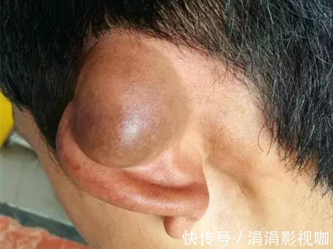 切除|年过50想长寿,要留心身上的4个“小凸起”,离癌症近的人才会有