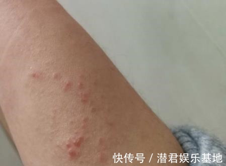带状疱疹|湿疹、脓包、带状疱疹等多种皮肤病,一个中药方外用!家中可常备